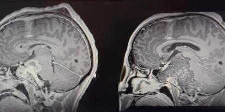 جدة.. استئصال ورم حبلي نادر من قاع جمجمة مريض خلال 35 ساعة - لايف نيوز