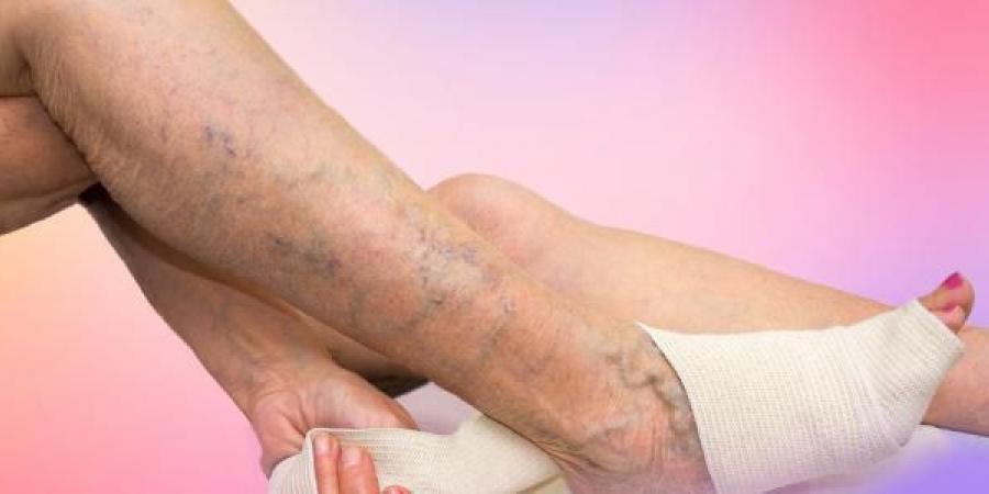 وداعًا للدوالي دون عمليات.. طرق فعالة لعلاج دوالي الساق في المنزل - لايف نيوز